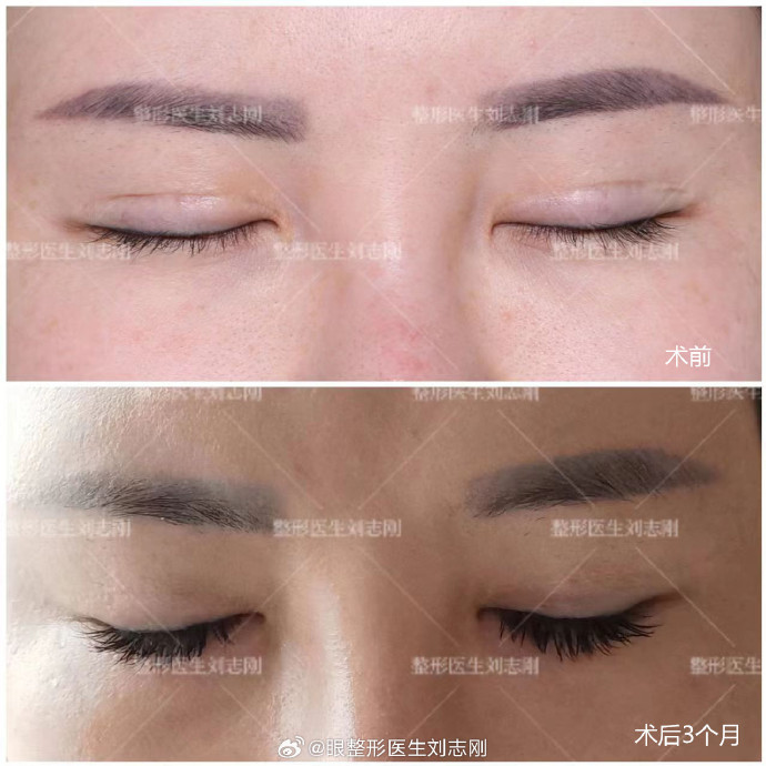 劉志剛雙眼皮修復(fù)案例