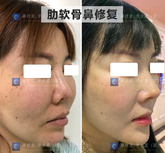 李長富鼻修復案例