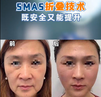 北京八大處謝洋春做拉皮手術(shù)怎么樣？