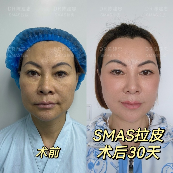 上海陳建忠做拉皮技術怎么樣？