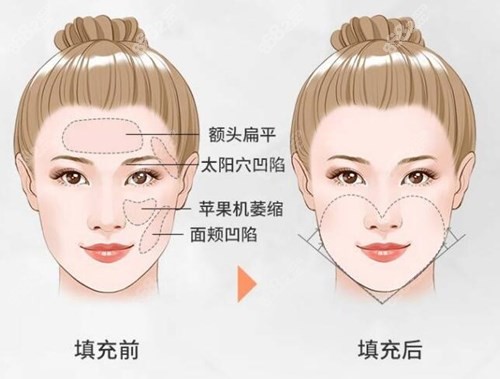 北京孫澤芳做面部脂肪填充技術(shù)怎么樣?