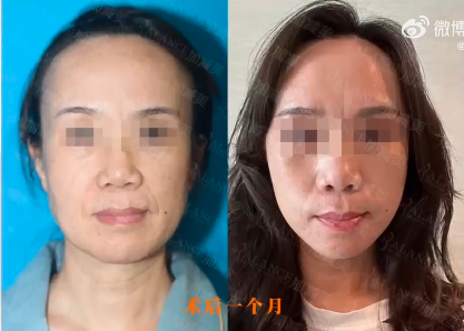 黃醫生拉皮案例