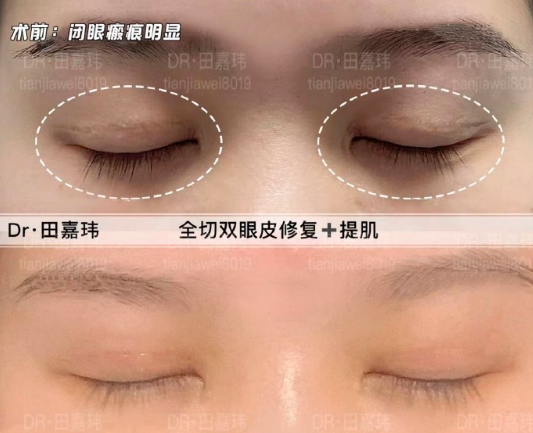 田嘉瑋眼修復案例