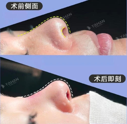 深圳鼻修復高山和李信峰哪個醫生好？