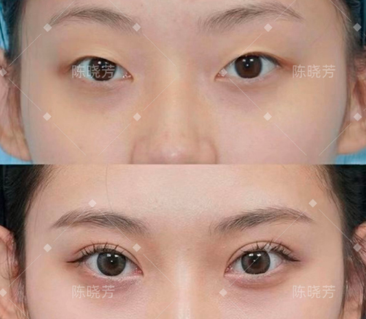 陳曉芳雙眼皮案例