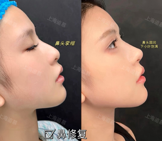 齊金杰鼻修復案例