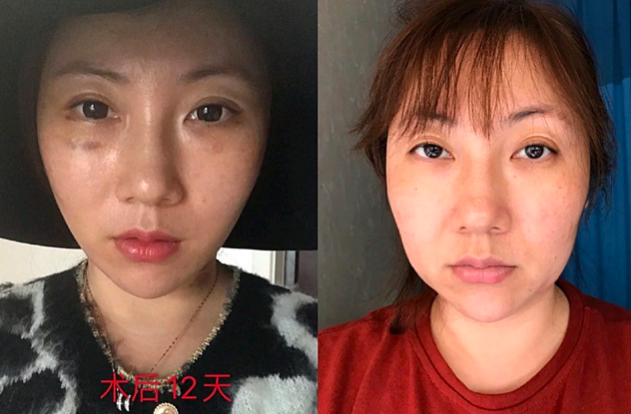 上海趙寅局做拉皮技術怎么樣？