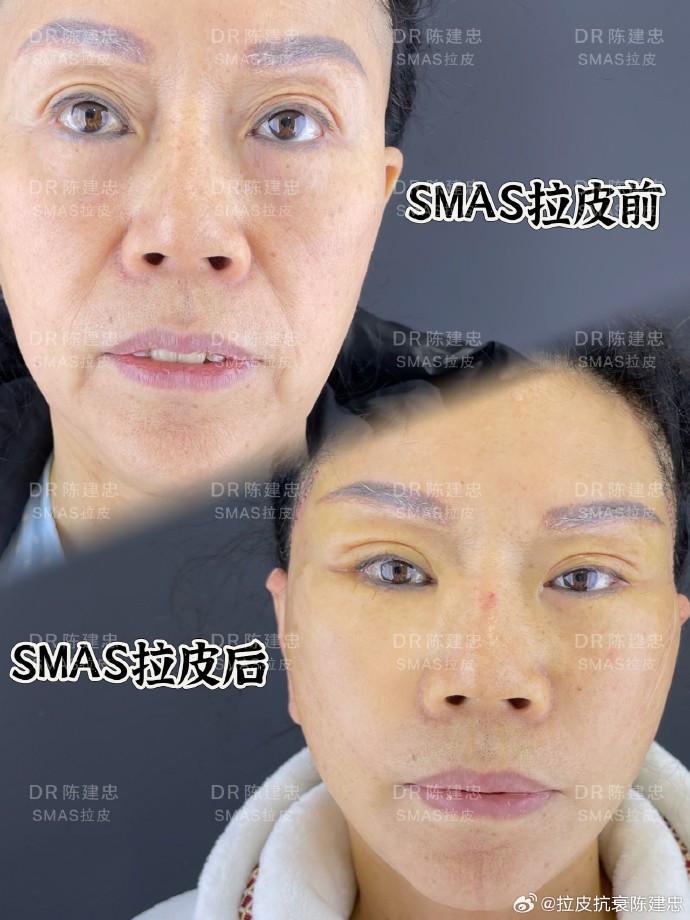 上海陳建忠醫(yī)生拉皮技術(shù)怎么樣