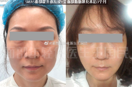 深圳王國民醫生做拉皮技術怎么樣?