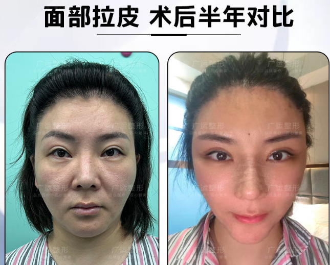 鄭州魏廣運(yùn)醫(yī)生做拉皮怎么樣？技術(shù)靠譜嗎？價(jià)格貴不貴？