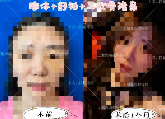 上海九院隆鼻戴婷婷和魏皎哪個(gè)好