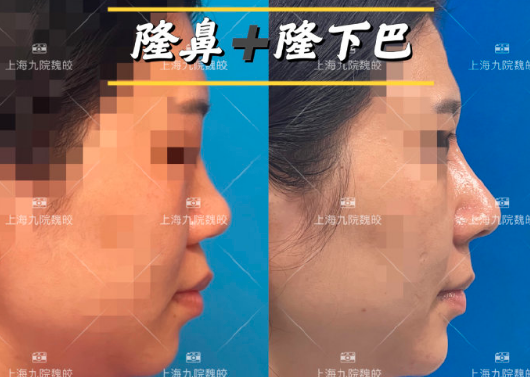 魏皎鼻綜合案例
