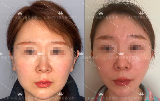 北京面部拉皮楊俊、杜太超、李曉東哪個醫生好？