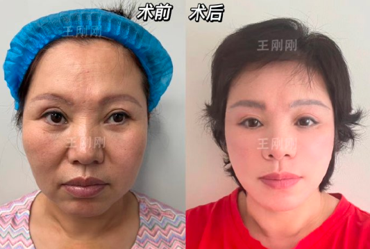 上海王剛剛做面部拉皮手術(shù)靠譜嗎？技術(shù)到底怎么樣？