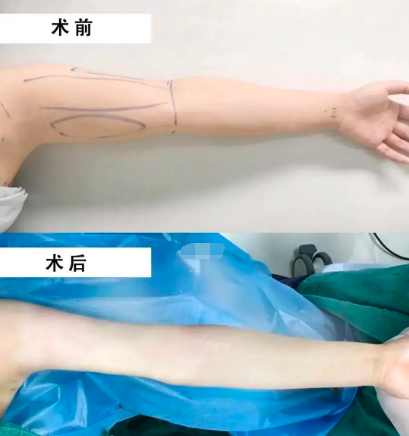 上海九院抽脂吸脂哪個醫生好