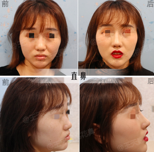 深圳王天國醫(yī)生做鼻子技術(shù)怎么樣