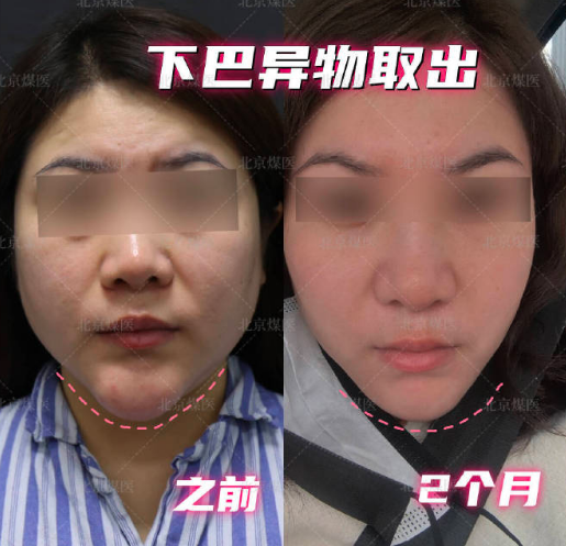 北京周云超取異物取出怎么樣？技術(shù)好不好？能取干凈嗎？