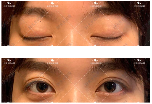 北京協(xié)和白明雙眼皮做的怎么樣？