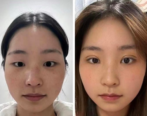 西安肖潮醫生雙眼皮做的怎么樣？