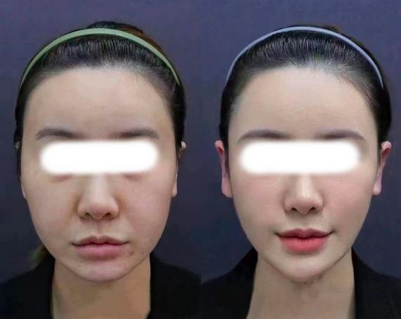 國內擅長做無痕筋膜提升的醫生有哪些？
