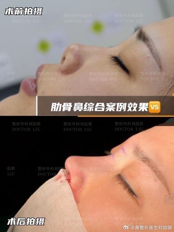 廣州劉喆騏醫(yī)生做的鼻子怎么樣