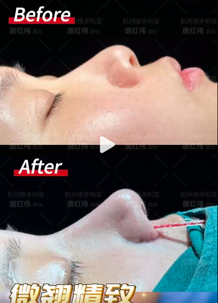 杭州唐紅偉做鼻子技術(shù)怎么樣