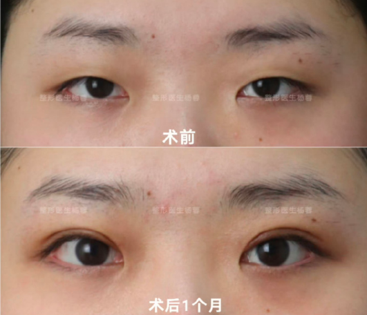 武漢楊蓉做雙眼皮技術(shù)怎么樣
