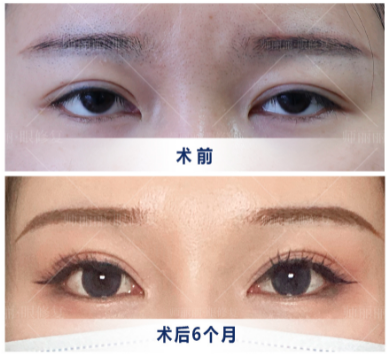 北京雙眼皮修復(fù)師麗麗怎么樣