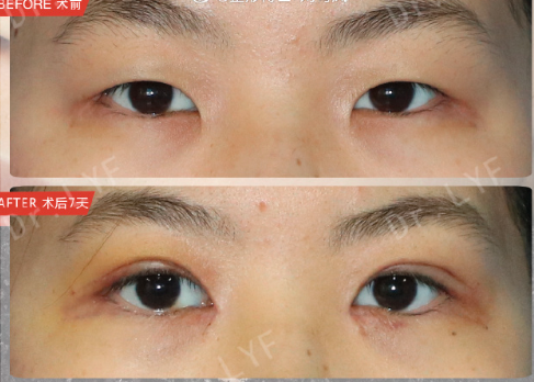 南京劉育鳳做雙眼皮怎么樣？