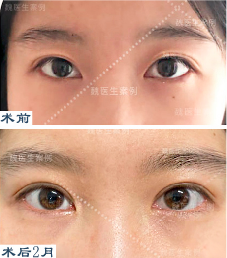 2024年北京雙眼皮修復手術(shù)最好的醫(yī)生是誰