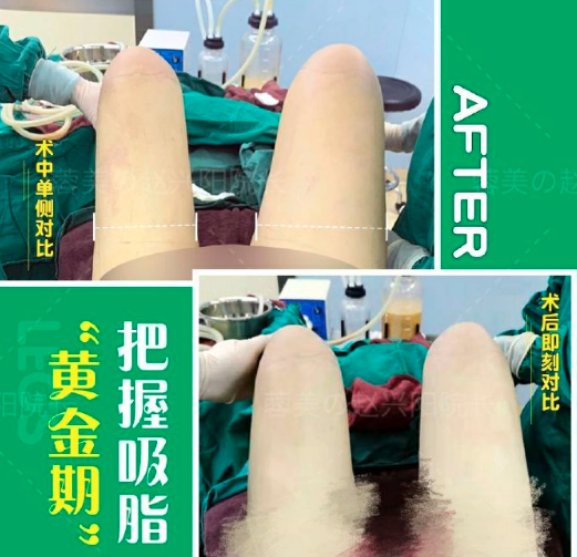 成都趙興陽吸脂技術怎么樣