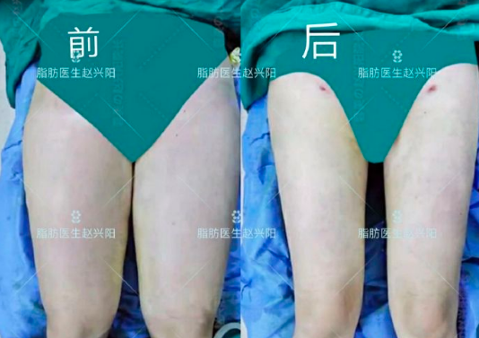 趙興陽吸脂案例