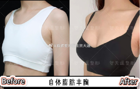 北京賀天遙醫生做脂肪豐胸技術怎么樣？