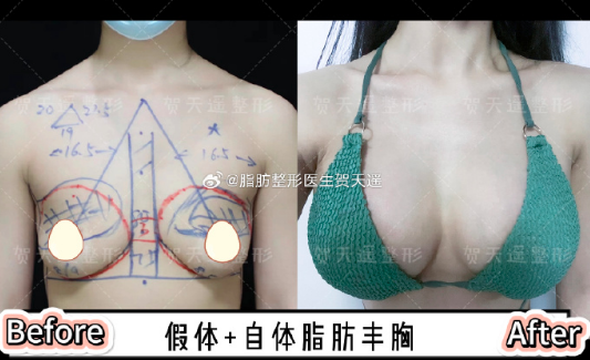 賀天遙脂肪豐胸案例