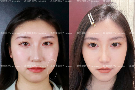 南京李國偉醫生做面部吸脂怎么樣？