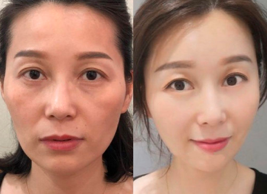 西安許龍順做微拉美技術(shù)怎么樣？