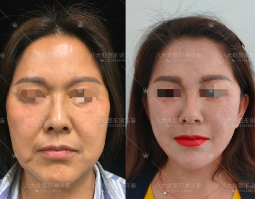 北京謝洋春和袁強(qiáng)誰的拉皮做的好