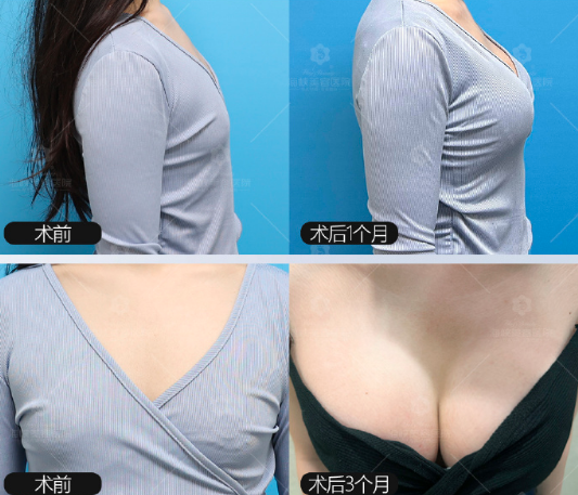 福州林沸騰內窺鏡隆胸怎么樣