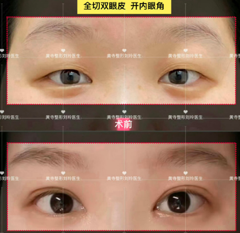 北京劉玲醫(yī)生做雙眼皮修復技術怎么樣？