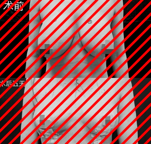 易成剛醫(yī)生巨乳縮小案例