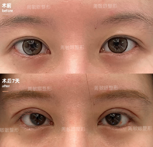 周敏做雙眼皮修復(fù)案例