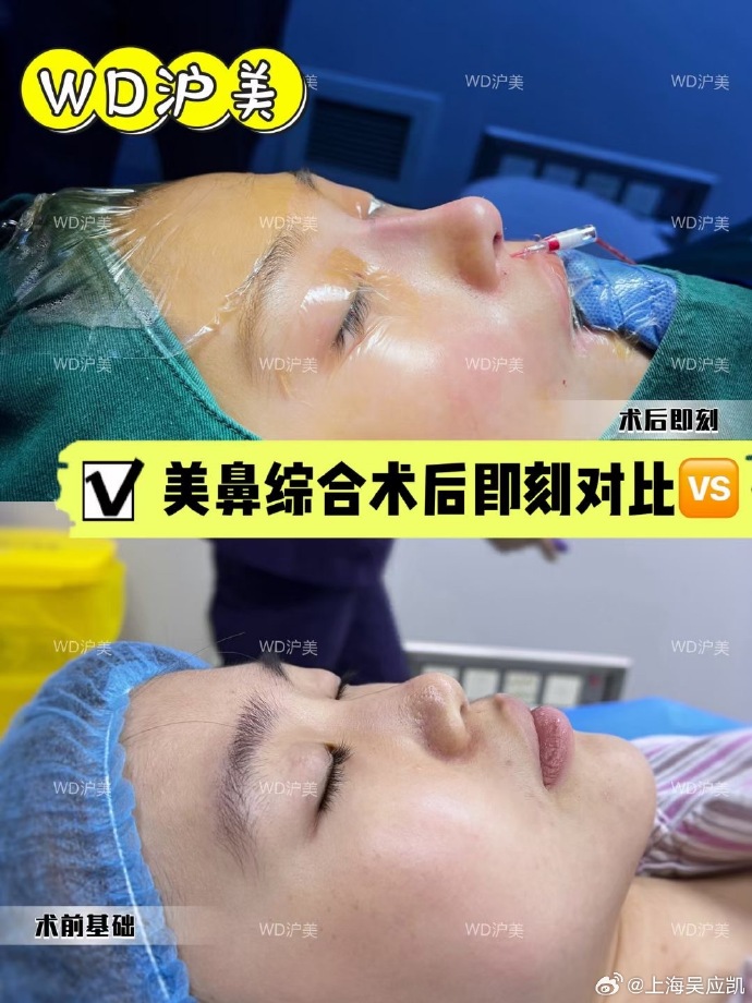 吳應凱隆鼻案例