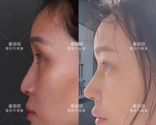 姜麗麗鼻修復案例