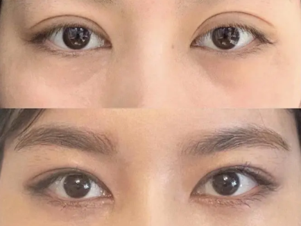 長沙雙眼皮手術最好的醫生是誰？