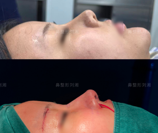 劉湘鼻修復案例